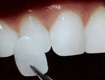 carillas dentales lima peru